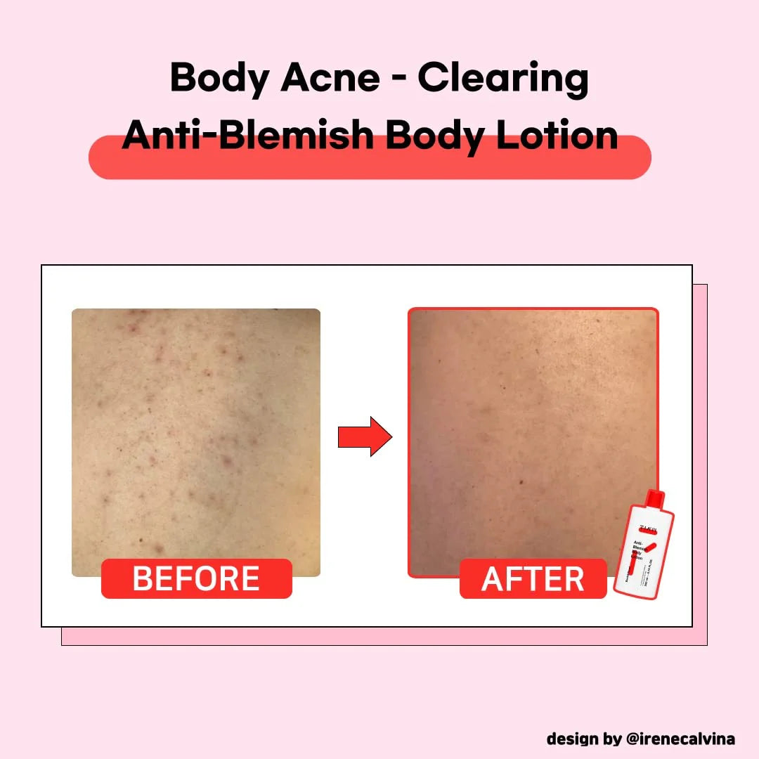 TIA’M Anti Blemish Body Lotion 200ml